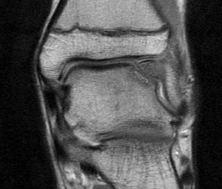 Talus OCD Anterolateral MRI0002